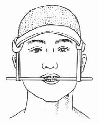 上颌骨骨折临时固定法