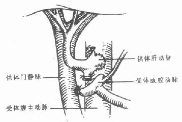 肝动脉吻合