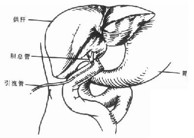 胆总管空肠Roux-en-Y吻合