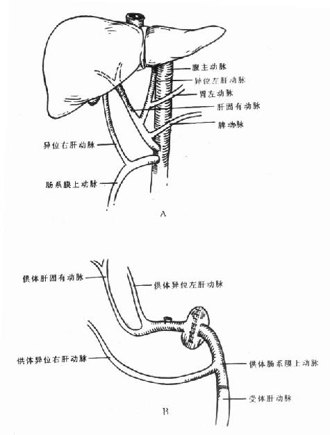 病人供肝体肝动脉变异情况