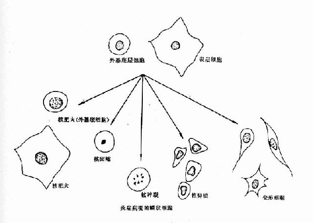 炎症病变的脱落上皮细胸形态改变示意图