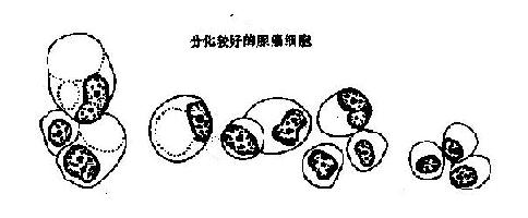 高分化腺癌细胞及其鉴别诊断