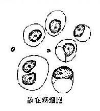 浆膜腔积液内大细胞型腺癌癌细胞示意图