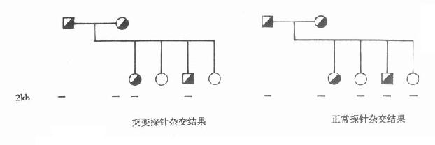 正常与突变苯丙氨酸羟化酶探针与PKU家系成员的DNA杂交结果