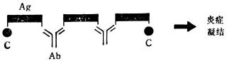  Ⅲ型变态反应示意图肾小球肾炎、风湿性关节炎或偏头痛