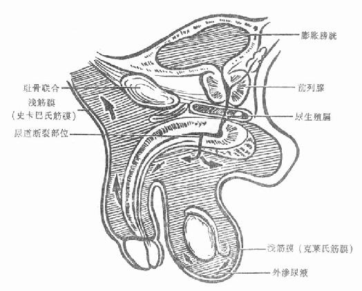 尿道球部创伤尿外渗范围