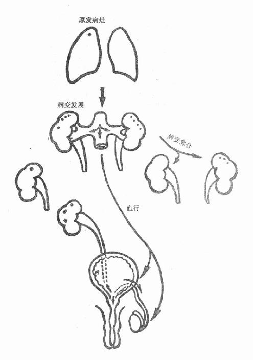 泌尿、男生殖系结核的感染途径