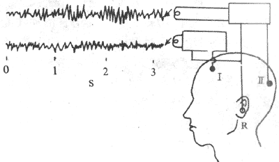 脑电图记录示意图