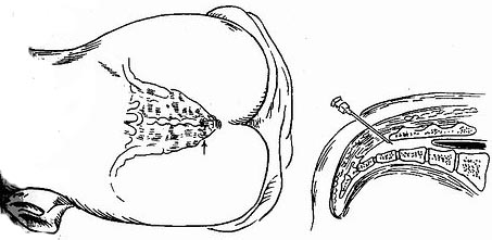 骶管穿刺术