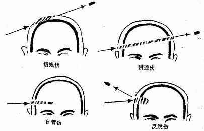 火器伤按伤道形态分类示意图