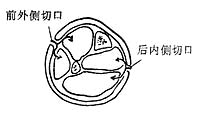 小腿两个皮肤切口，切开四个筋膜间室减压示意图