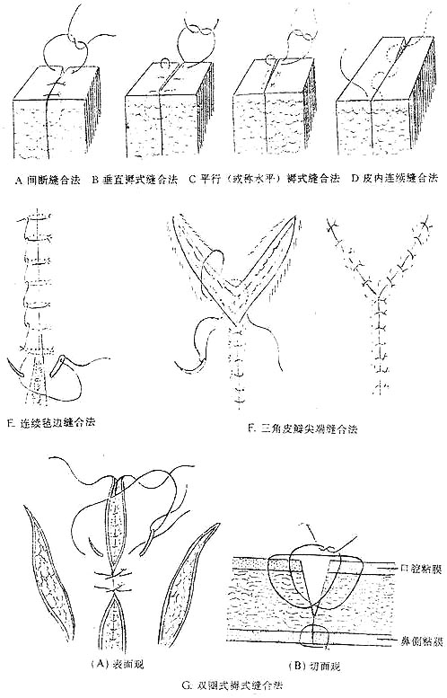 各种缝合皮肤切口的方法