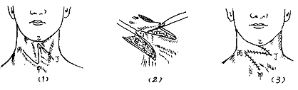 Z形皮瓣修复颈条索状疤痕挛缩（可延长挛缩方向的长度）