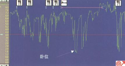 GERD患者24小时pH监测图