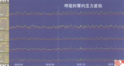 五条压力通道均在胃内记录到的压力曲线