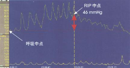 RIP处LES压力