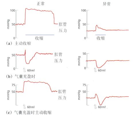 一例肛门外括约肌功能减弱患儿与正常儿童肛门直肠测压