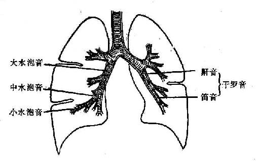 罗音的发生机理示意图