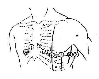 胸导联探查电极的位置