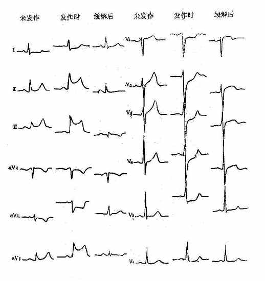 变异型心绞痛发作时心电图