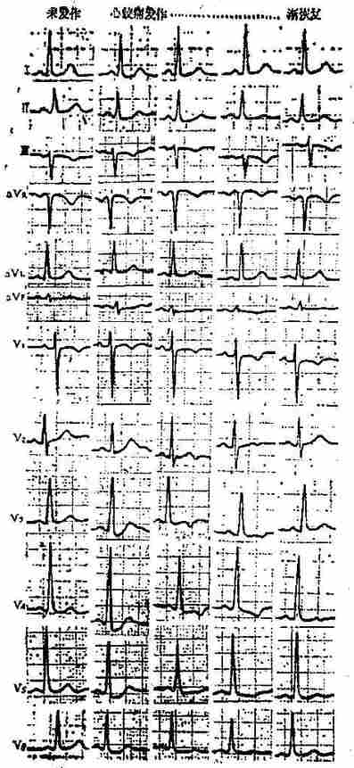 心绞痛发作心电图演变