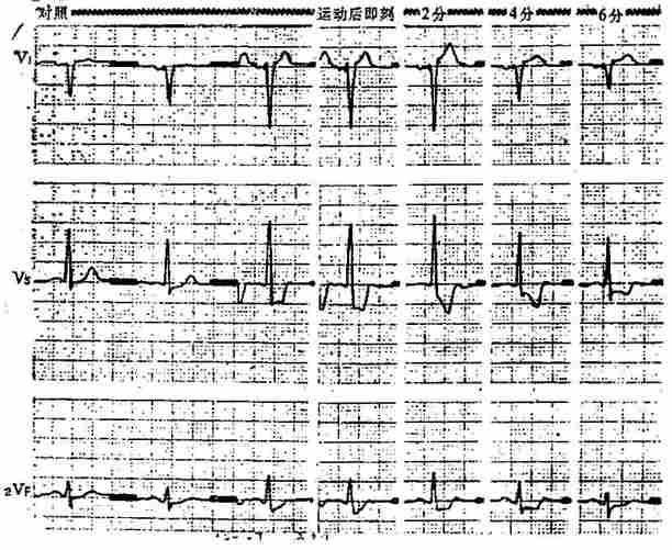 运动试验阳性心电图