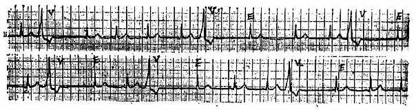 交界性逸搏心电图一例