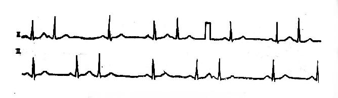 房性期前收缩形成三联律心电图一例