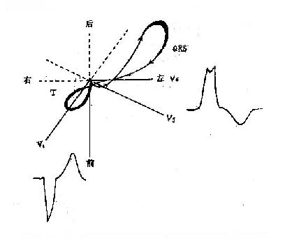 左束支传导阻滞的横面QRS向量环示意图