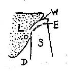 胆囊结石“WES”征