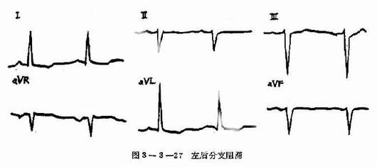 左后分支阻滞