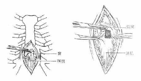 剑突下心包开窗术