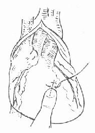 心脏裂口缝合法之一