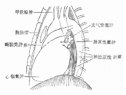 纵隔肿瘤及囊肿多发部位示意图