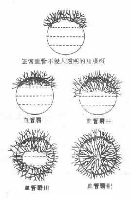 沙眼角膜血管翳