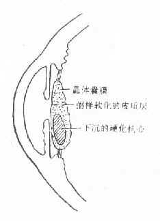 过熟期白内障