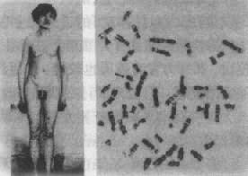 Klinefelter综合征患者及其核型