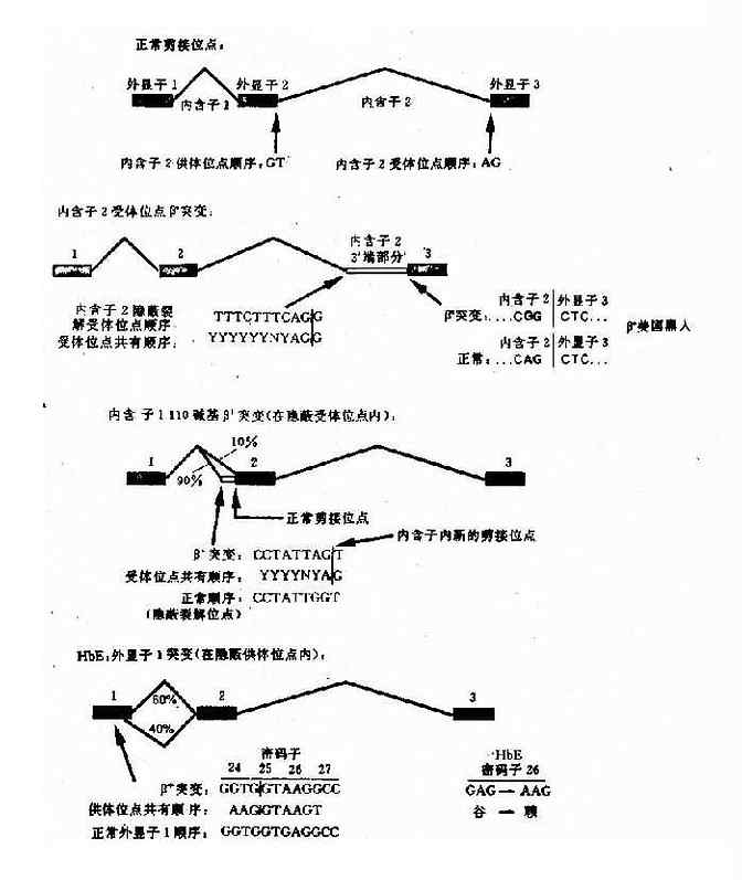 干扰正常β珠蛋白剪接的突变举例