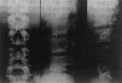 正常腰椎（正位、侧位、斜位）