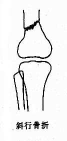 各型骨折示意图-斜行骨折