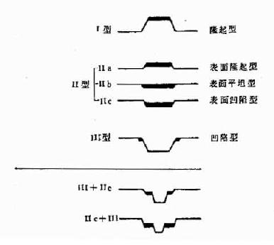 早期胃癌分型