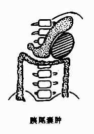 胰腺囊肿