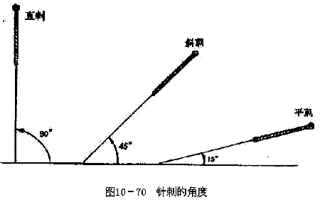 针刺的角度