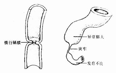 消化管狭窄或闭锁 